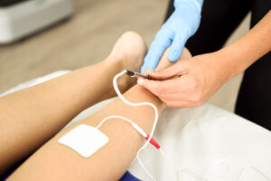 Dry Needling with Electrical Stimulation